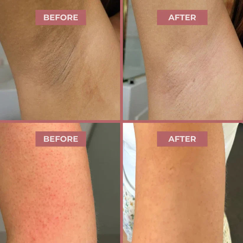 Herline BodyClear™ Kojik Asit + Zerdeçal Vücut Peeling Spreyi